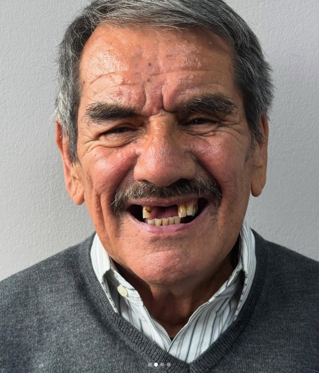 Antes y después de una armonización facial con rehabilitación de sonrisa