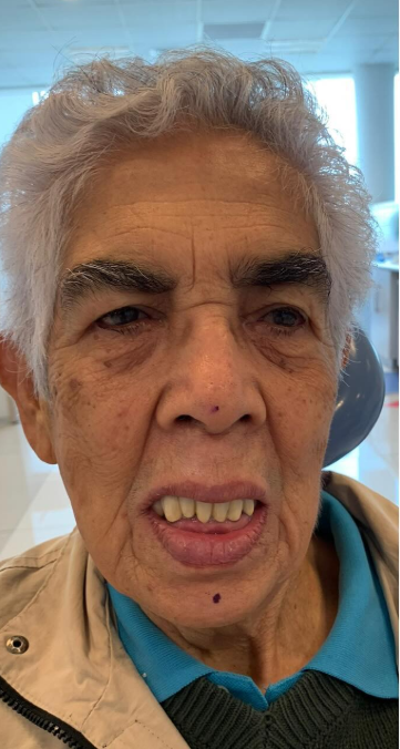 Antes y después de una rehabilitación oral completa